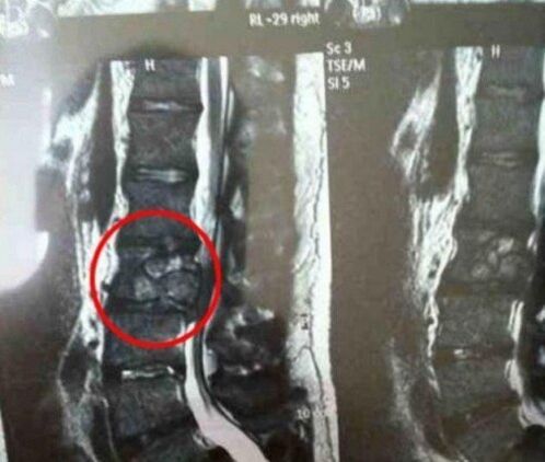 La tumeur vertébrale sala sur l'image