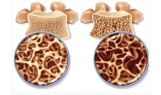 Danger de l'œil cervical pour les femmes