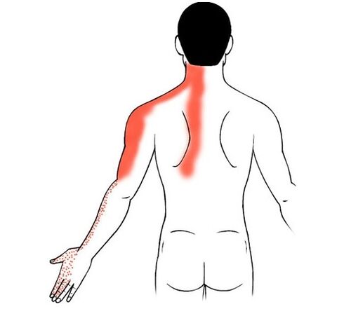 ostéochondrose cervicale comme cause de douleurs dans les articulations des doigts