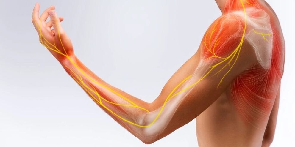 La douleur et l'engourdissement dans les doigts indiquent des dommages aux ligaments dus à une ligamentite sténosante
