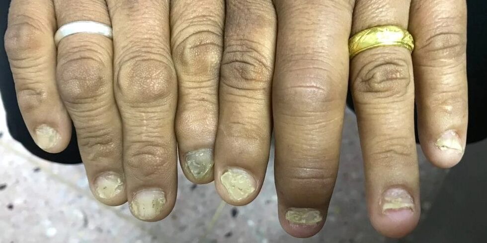 Un gonflement des doigts et une déformation de la plaque à ongles peuvent indiquer le développement d'un rhumatisme psoriasique.