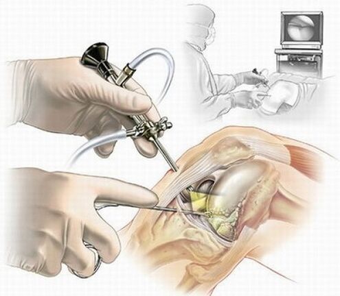 Arthroscopie du genou pour arthrose