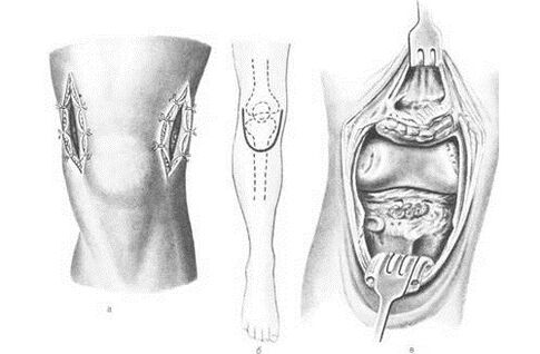 Chirurgie d'arthrotomie pour l'arthrose